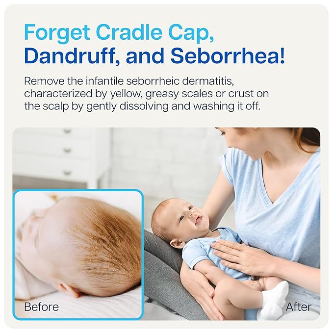 NAVEH PHARMA Cradle Cap Cleanser For Baby & Kids | 100% Natural Cradle Cap Treatment | Spray & Wash No Scrubbing | Better Than Shampoo Or Brush | Help With Dandruff | Olive Oil & Squalane | 1 FL OZ